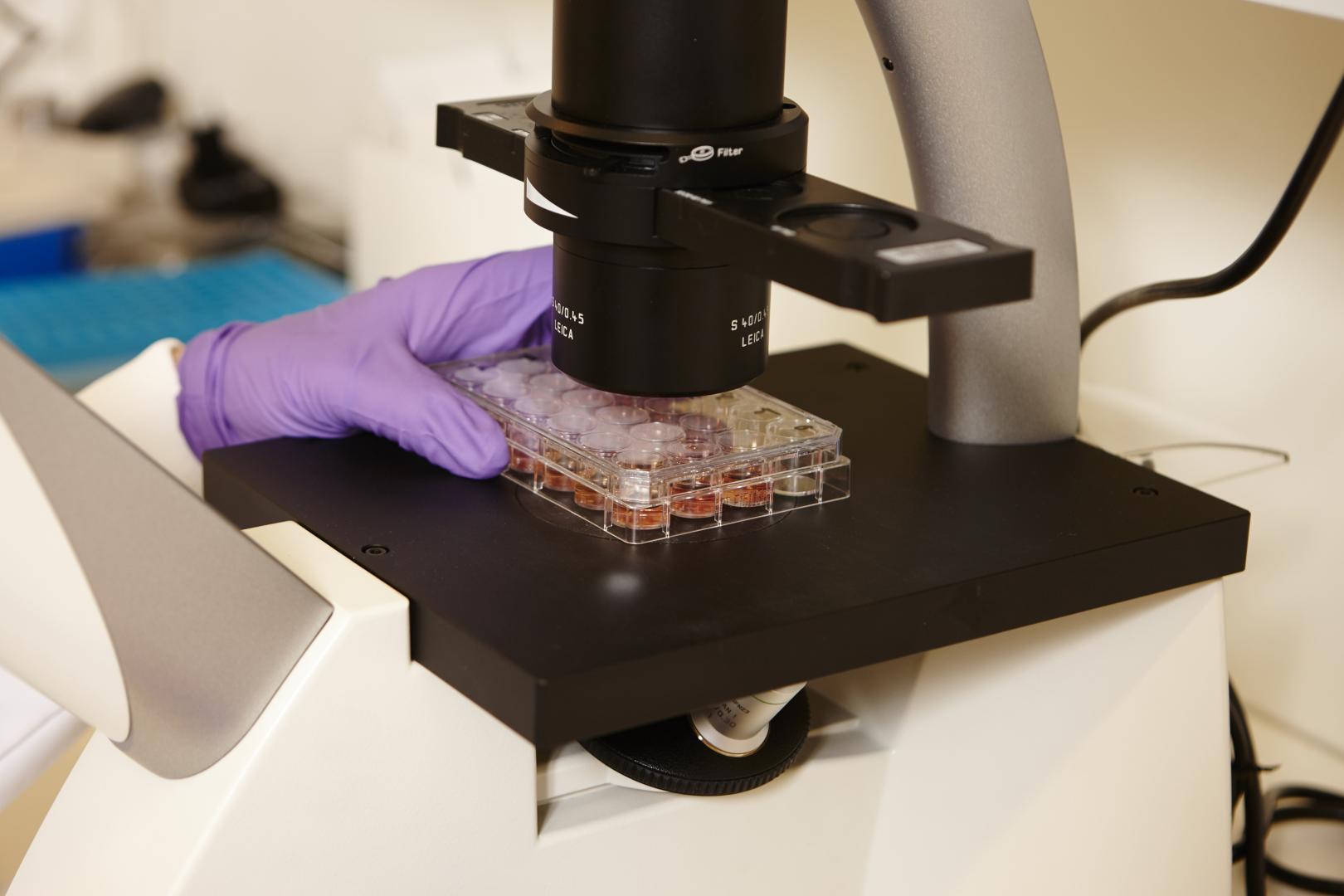 acute lymfatische leukemie